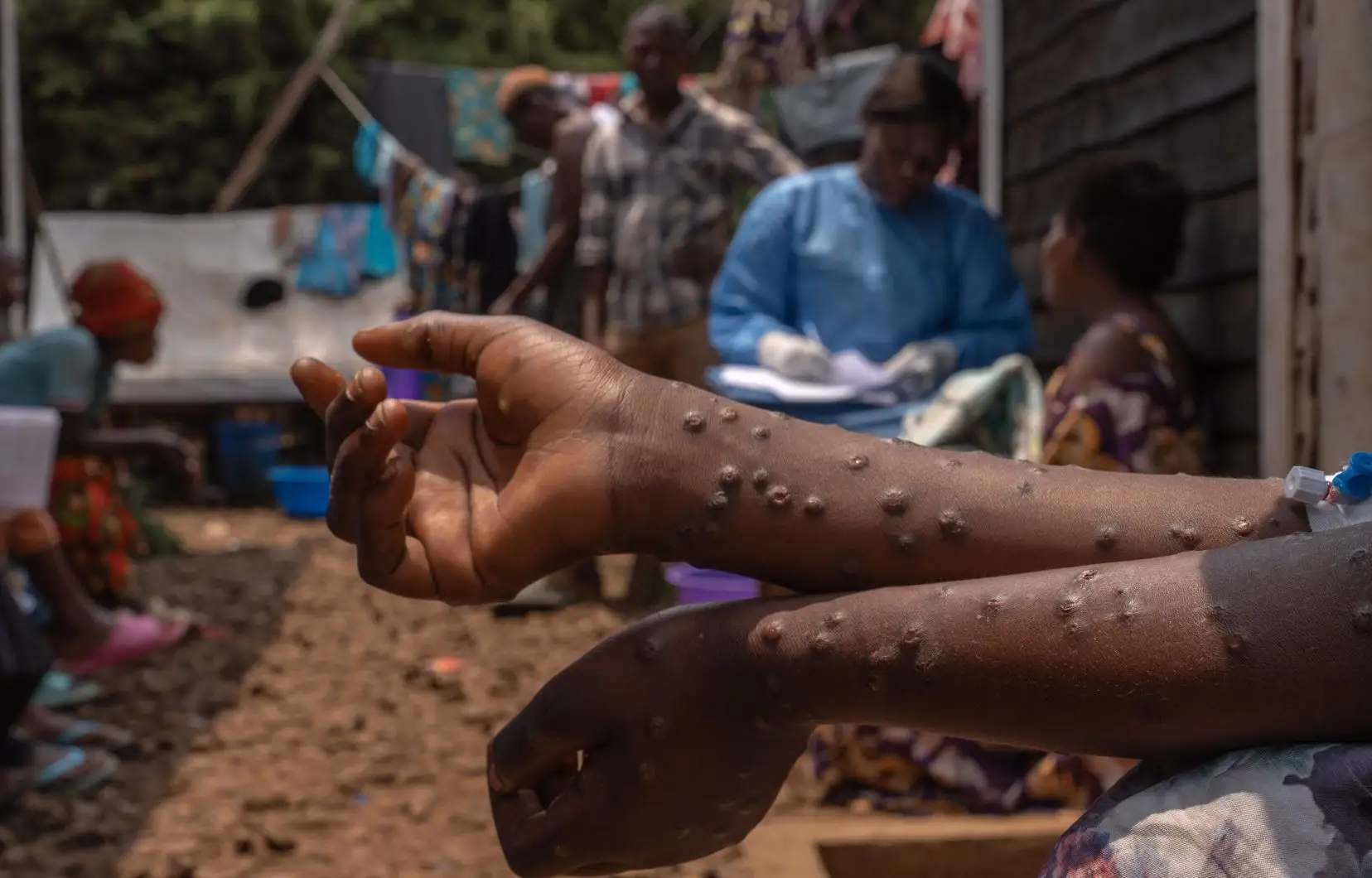 Comment se protéger du MPOX : Conseils essentiels pour minimiser les risques